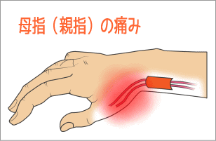 ドケルバン画像